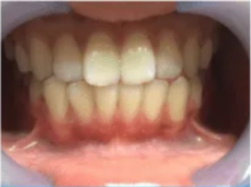 Female, 20 — college student, teeth before whitening