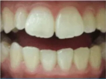 Female, 30 — office worker, teeth after one whitening session
